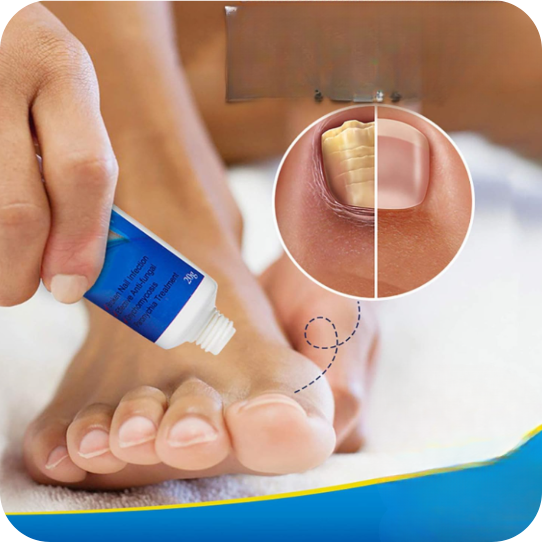 Anti-Fungal Foot Cream | NailFungus