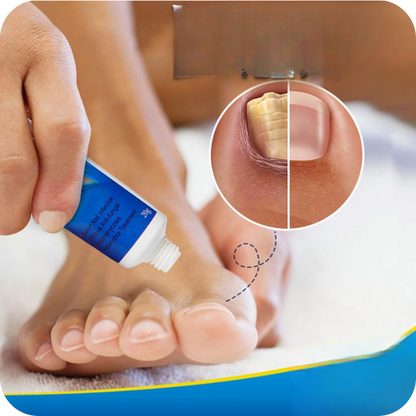 Anti-Fungal Foot Cream | NailFungus