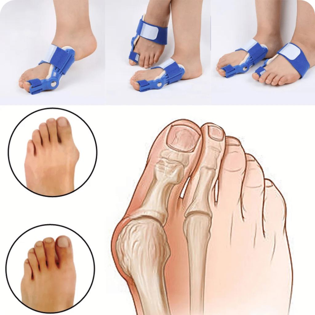 Orthopedic Bunion Corrector | PediFlex