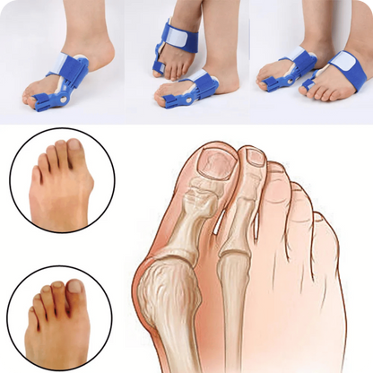 Orthopedic Bunion Corrector | PediFlex