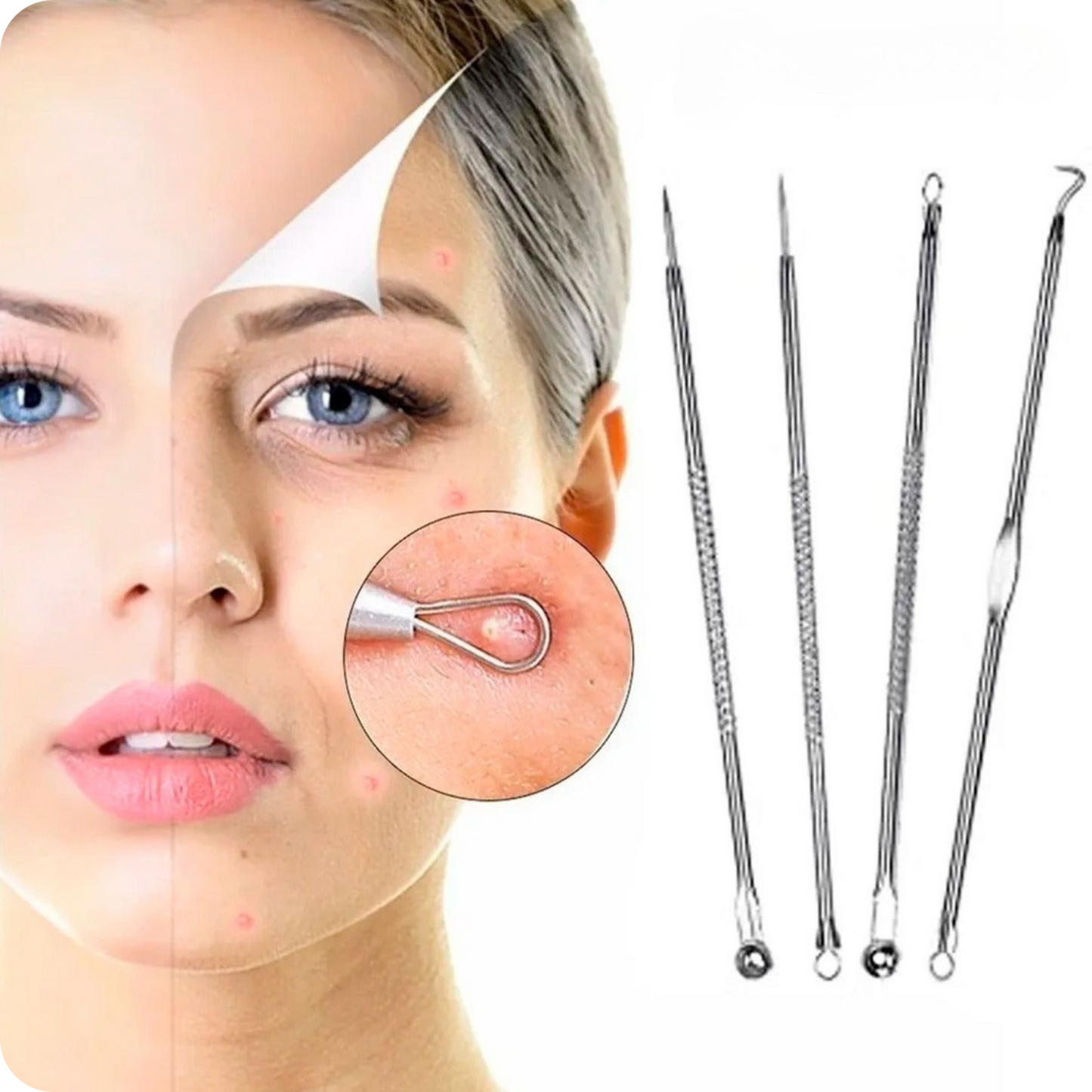 Blackhead Extractor Kit of 4 | DermaClear